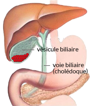Lithiase biliaire